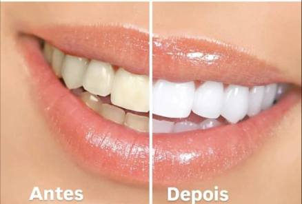 Antes e depois de clareamento dental