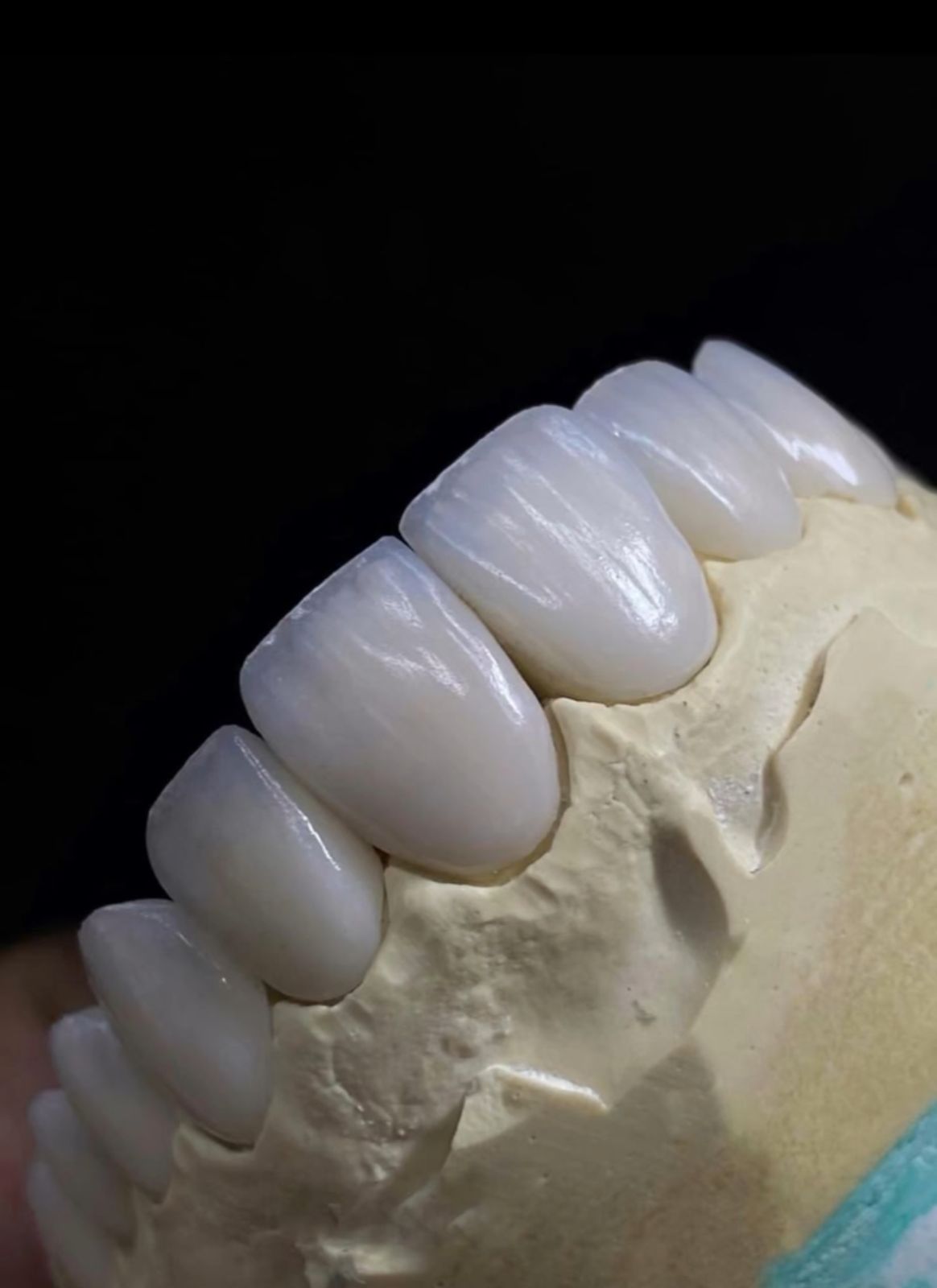 Lentes dentais prontas antes da cimentação