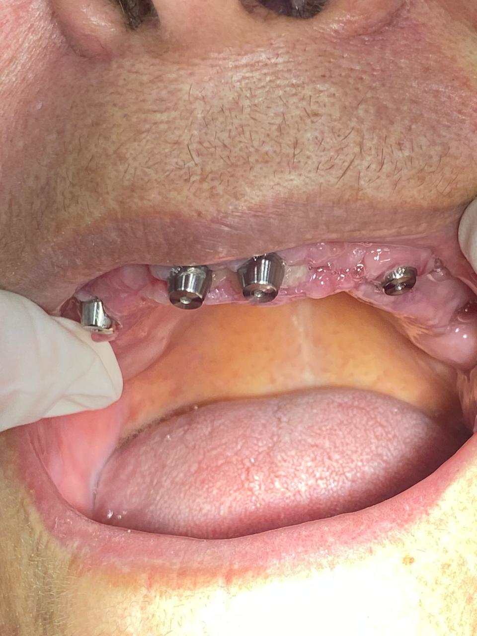 Componentes protéticos sobre implantes durante o tratamento
