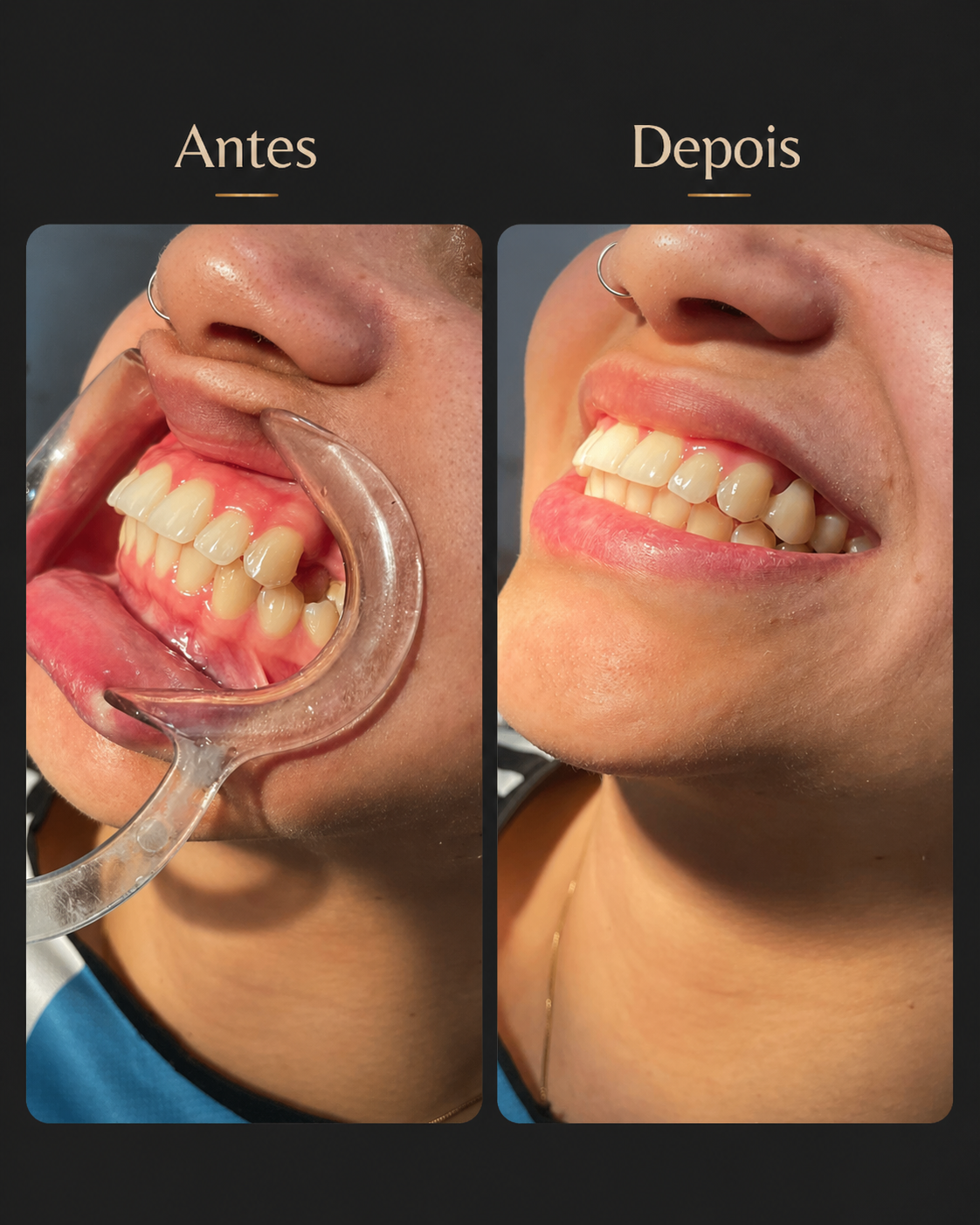 Antes e depois de implante unitário com provisório imediato